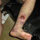 Illustration for article titled How A Softball Almost Killed This Mans Foot
